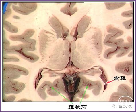 禽距裂|神经解剖学习笔记：脑回、脑沟